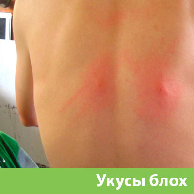 Укусы блох в Дубне
