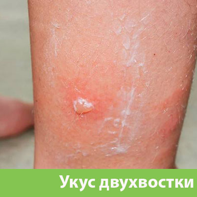 Укус двухвостки в Дубне