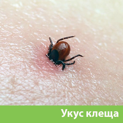 Укус клеща в Дубне