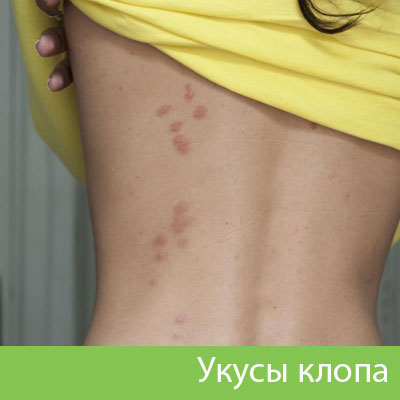Профессиональное уничтожение клопов в Дубне